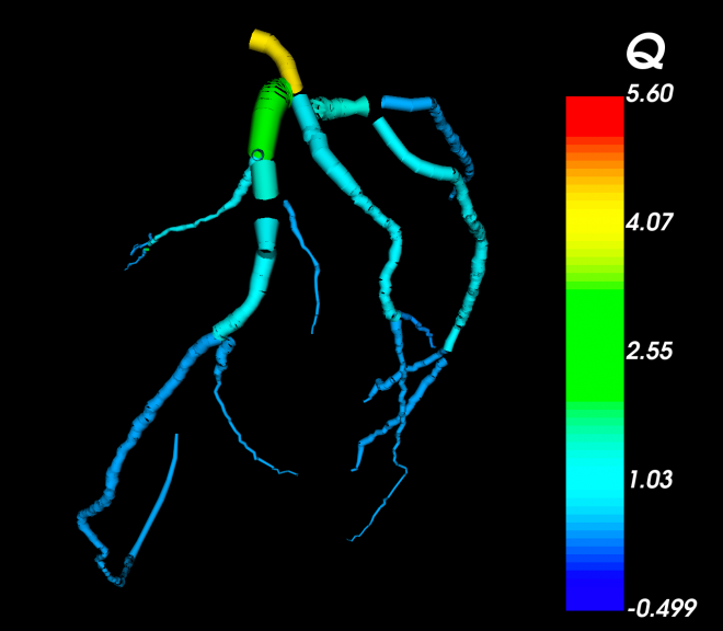 Modelling Coronary Artery Bypass Grafts New Zealand Escience Modelling Coronary Artery Bypass Grafts New Zealand Escience